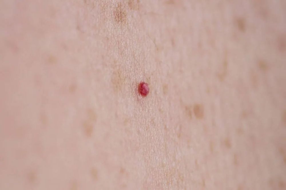 皮肤上长出的小红点，到底是什么？(图1)