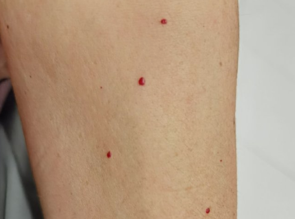 皮肤上长出的小红点，到底是什么？(图4)